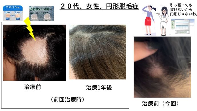 円形脱毛症　病院